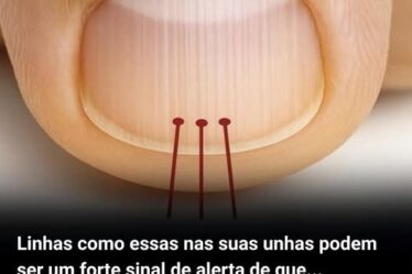 O que pode significa aquelas linhas nas unhas